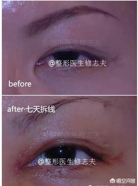 割双眼皮到底该不该开不开眼角?