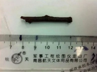 4厘米树枝刺入幼儿右眼30天 湘雅专家巧“拔刺”