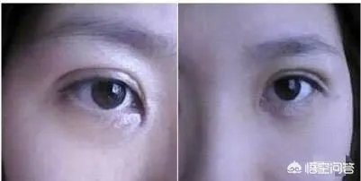 割双眼皮到底该不该开不开眼角?