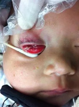 4厘米树枝刺入幼儿右眼30天 湘雅专家巧“拔刺”