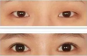 割双眼皮到底该不该开不开眼角?