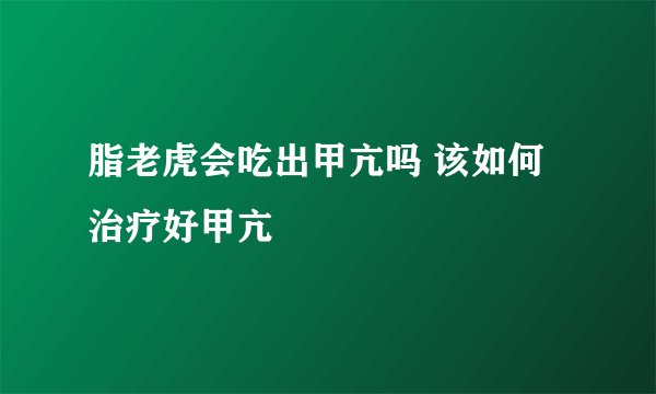 脂老虎会吃出甲亢吗 该如何治疗好甲亢