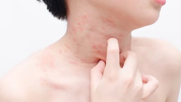 皮肤过敏是什么症状