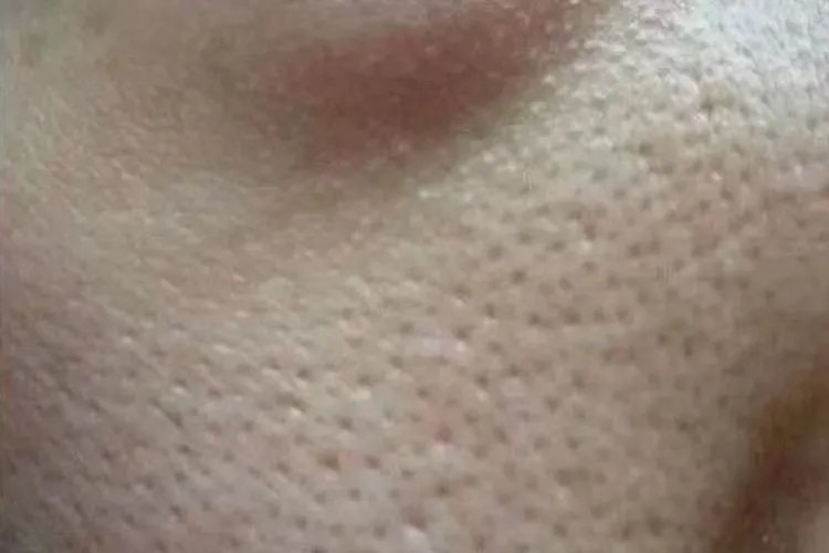 毛孔是什么样子的
