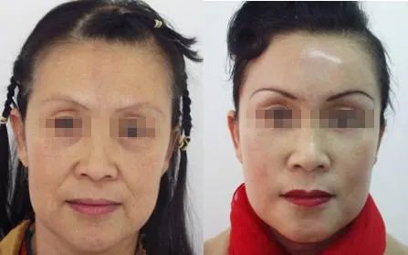 激光美容一般多少钱