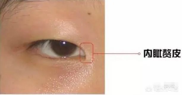 割双眼皮到底该不该开不开眼角?
