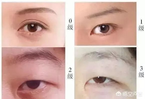 割双眼皮到底该不该开不开眼角?