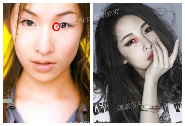 割双眼皮到底该不该开不开眼角?