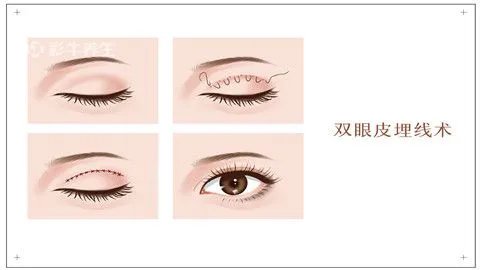 割双眼皮的价格