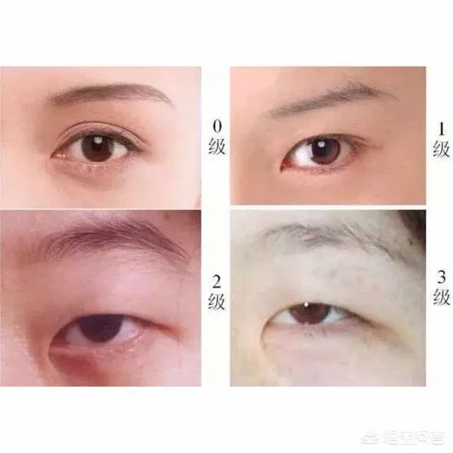 割双眼皮到底该不该开不开眼角?