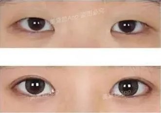 割双眼皮到底该不该开不开眼角?