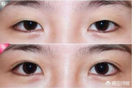 割双眼皮到底该不该开不开眼角?