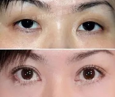 割双眼皮到底该不该开不开眼角?
