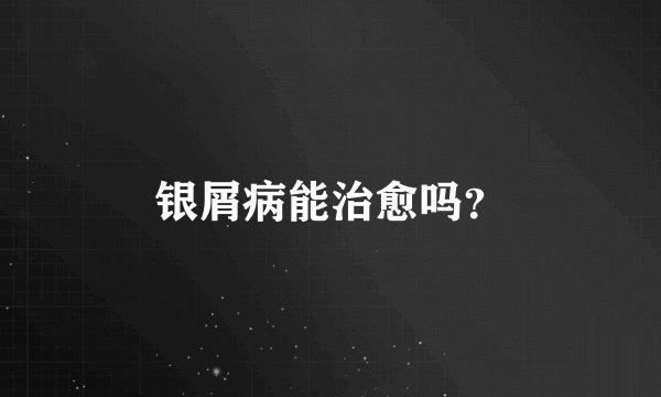 银屑病能治愈吗？