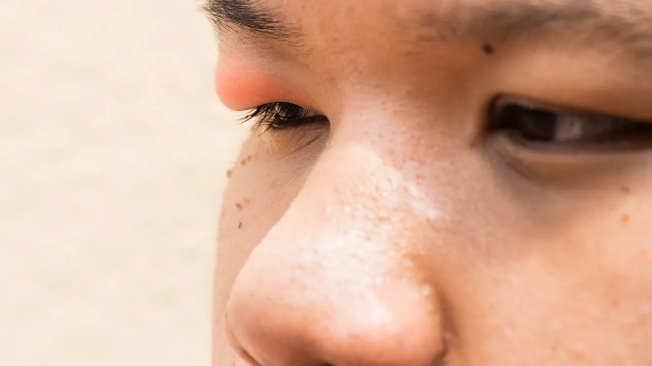 如何治疗眼球出血