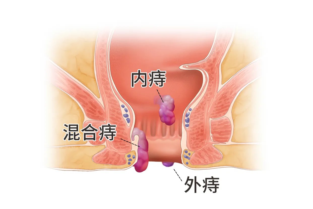 轻度痔疮图片大全