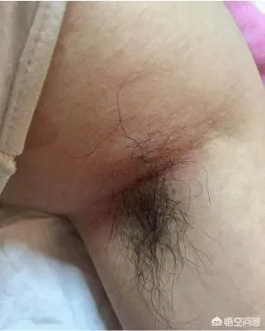怎样简单除腋毛?