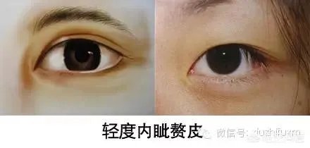 割双眼皮到底该不该开不开眼角?
