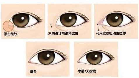 割双眼皮到底该不该开不开眼角?