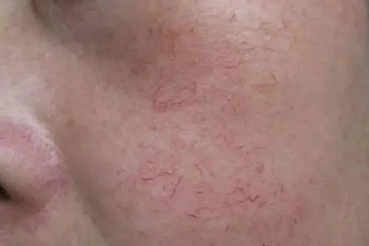 红血丝分为哪几种图片