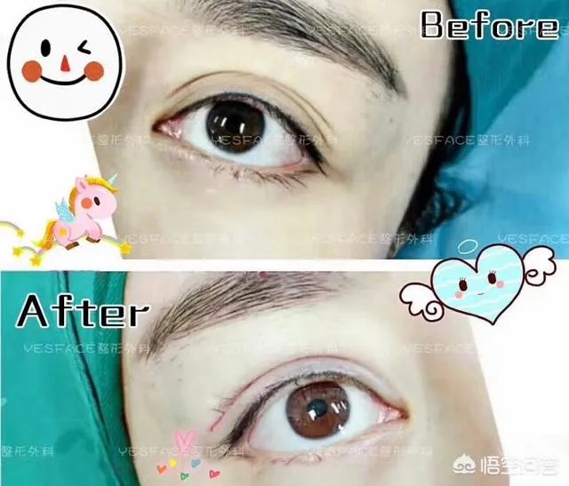 割双眼皮到底该不该开不开眼角?
