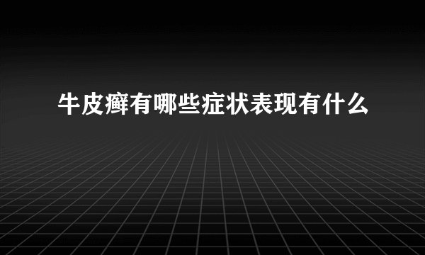 牛皮癣有哪些症状表现有什么