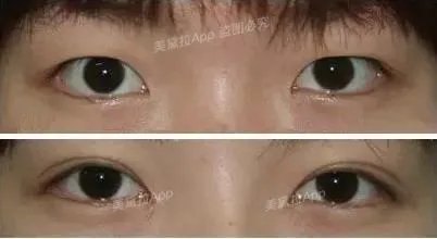 割双眼皮到底该不该开不开眼角?