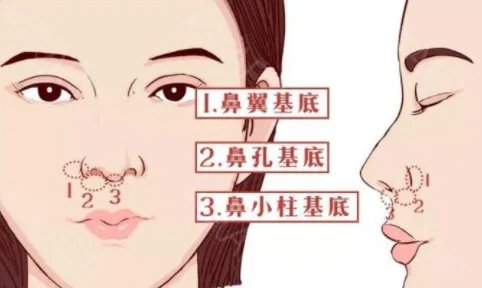 重庆华美整形外科医院玻尿酸垫鼻基底怎么样?价格一般多少钱